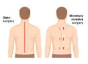 Minimally Invasive Spine Surgery