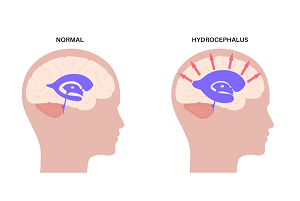 Hydrocephalus