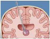 Colloid Cyst