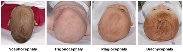 Craniosynostosis